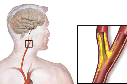 Kardiyoloji Uzman'ından şah damarı tıkanıklığı ve inme uyarısı: Her yıl 200 bin kişi inme geçiriyor!